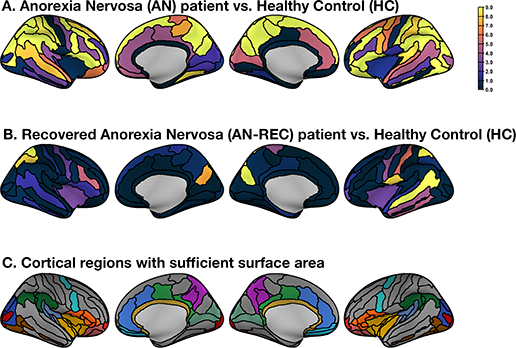 Cortical Complexity in Anorexia Nervosa: A Fractal Dimension Analysis
